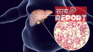 लिवर के लिए तेल और घी ही नहीं ये सफेद चीज भी है जहर, फैटी लिवर और सूजन का है कारण