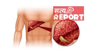 फैटी लिवर को हल्के में न लें, धीरे-धीरे बढ़ता है लिवर सिरोसिस का खतरा