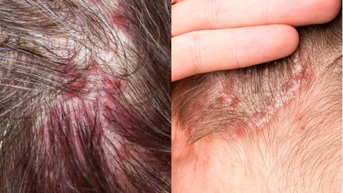 Scalp Folliculitis,Prevention Tips,Dermatologist Advice,Sweat & Bacteria,scalp acne causes folliculitis symptoms, scalp infection treatment