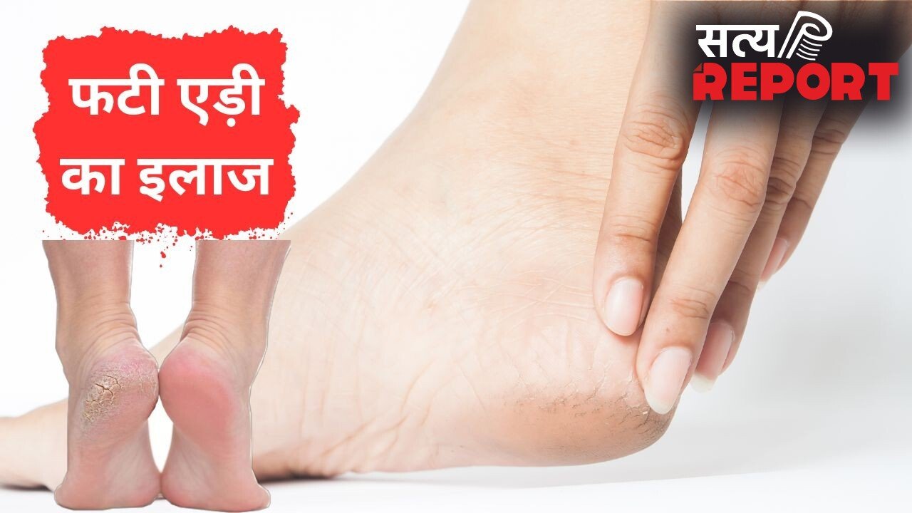 गर्मी में भी फट जाती हैं एड़ियां, इस तरह मुलायम बनाने और दरारें भरने में मिलेगी मदद, बरतें ये सावधानी