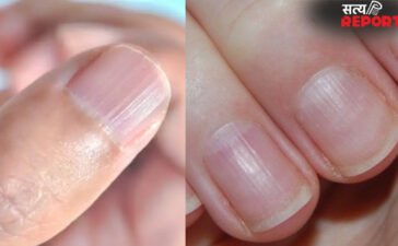 नाखून पर उभरी धारियां किस बात का संकेत है, क्यों बन जाती हैं लाइन, जानिए शरीर में किस कमी के कारण ऐसा होता है