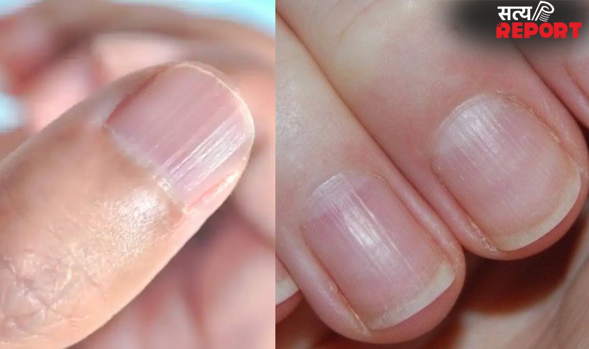 नाखून पर उभरी धारियां किस बात का संकेत है, क्यों बन जाती हैं लाइन, जानिए शरीर में किस कमी के कारण ऐसा होता है