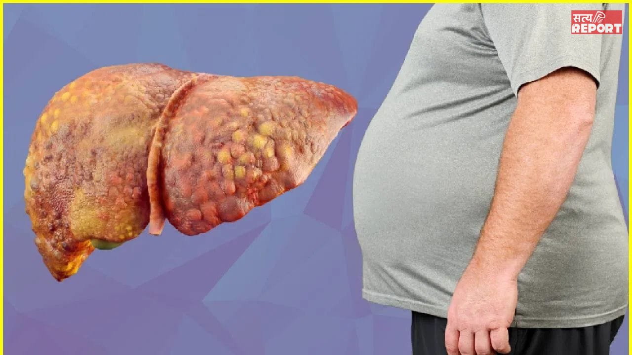 ग्लोबल लेवल पर तेजी से बढ़ रही लीवर की समस्या, लैंसेट रिपोर्ट का दावा- 2050 में हो जाएंगे 2 अरब लोग पीड़ित