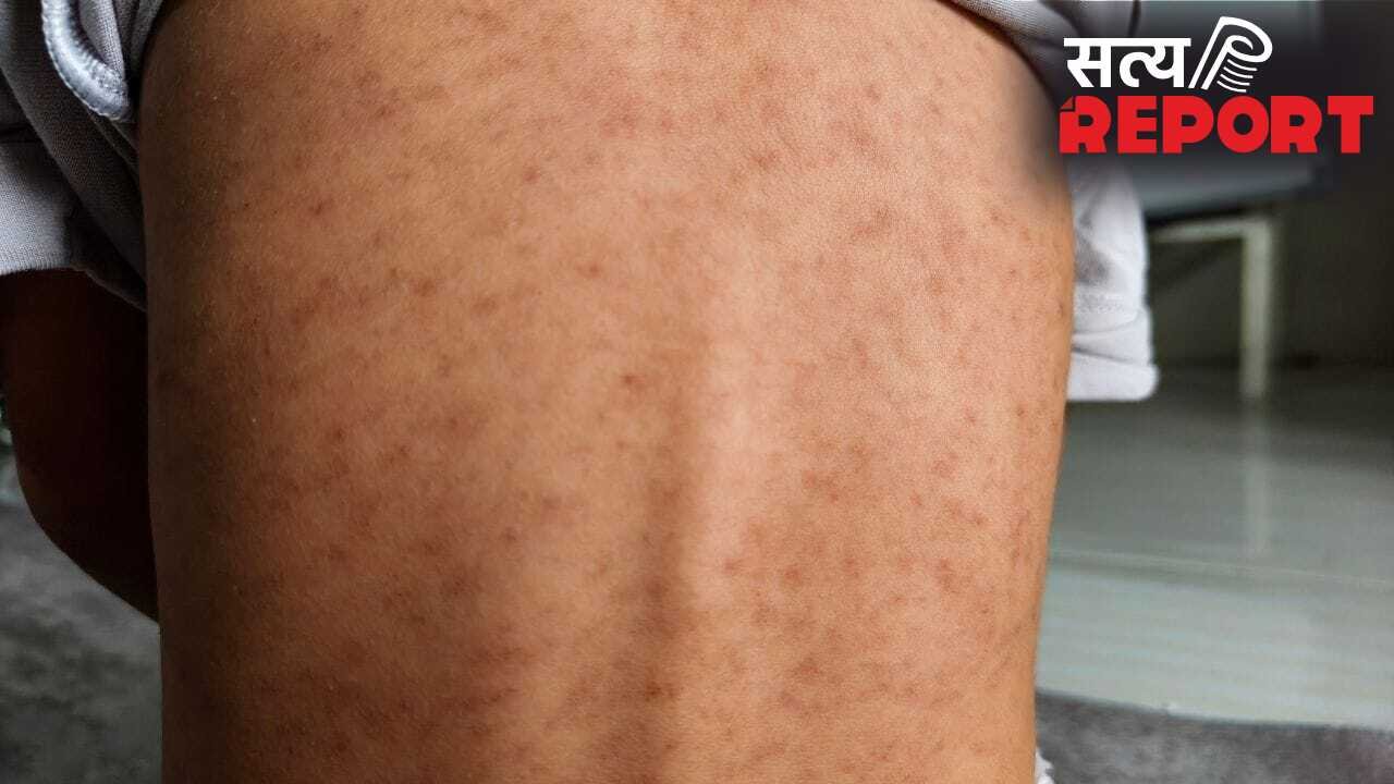 चेन्नई में खसरा के मामले बढ़े, जानें कारण, लक्षण और बचाव