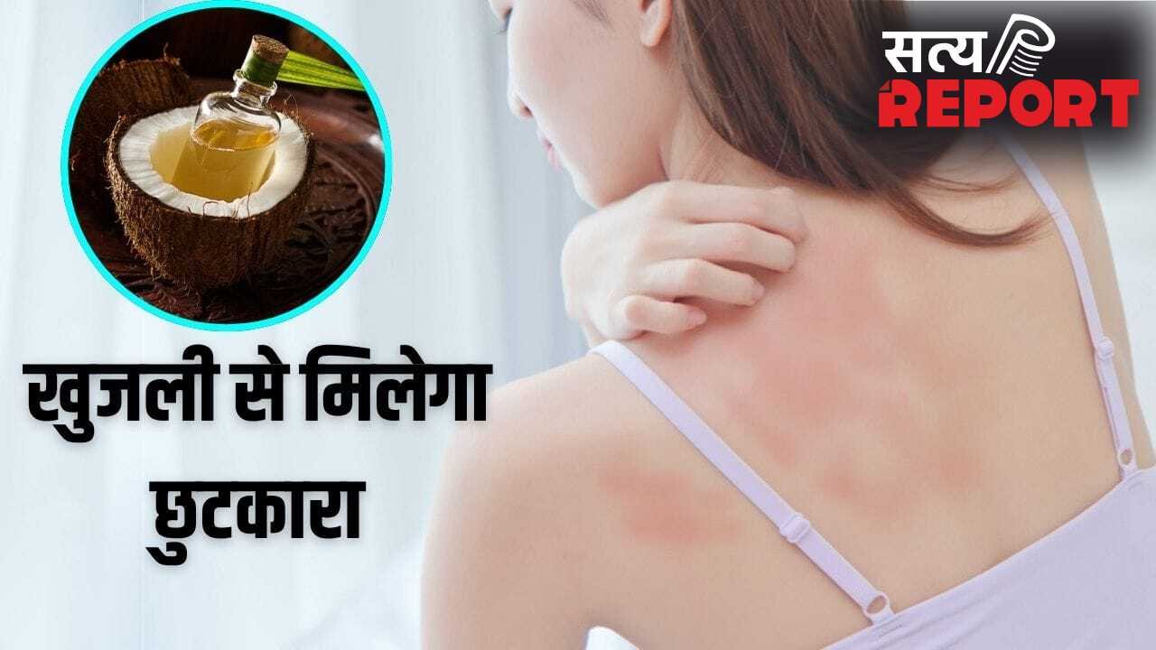 Summer Skin Care Remedy: गर्मी से हो रही खुजली-महीन दानों का होगा सफाया, नारियल तेल में मिलाकर लगा लें ये 1 चीज