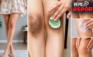 शॉर्ट ड्रेस पहनने के बाद डार्क दिखते हैं घुटने, कालापन छिपाने के लिए अपनाएं ये तरीके