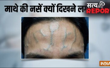 माथे की नसें क्यों दिखने लगती हैं, नस फड़कने पर क्या करें, जानिए इसके कारण और ठीक करने के उपाय माथे की नसें क्यों दिखने लगती हैं, नस फड़कने पर क्या करें, जानिए इसके कारण और ठीक करने के उपाय