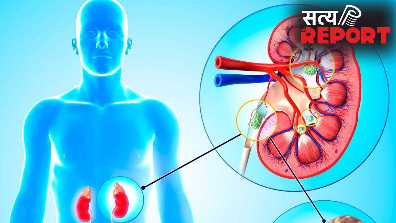 किन चीजों को खाने से किडनी में स्टोन बनता है? डॉक्टर ने बताया