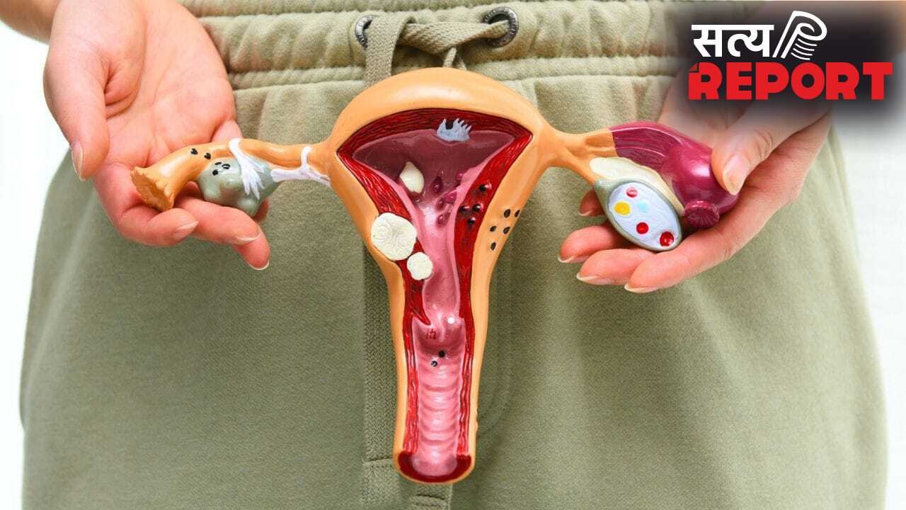 महिलाओं में PCOS का सबसे बड़ा कारण क्या है? कैसे बनता है बांझपन की वजह