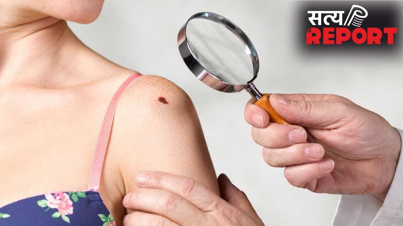 शरीर पर मौजूद तिल सुरक्षित है या सेहत के लिए खतरनाक? ऐसे करें पहचान
