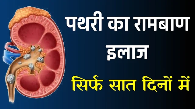 सिर्फ 7 दिन में 21mm की पथरी को गला देगा ये 40 रूपये का घरेलु उपाय, जरूर पढ़े और शेयर करे…
