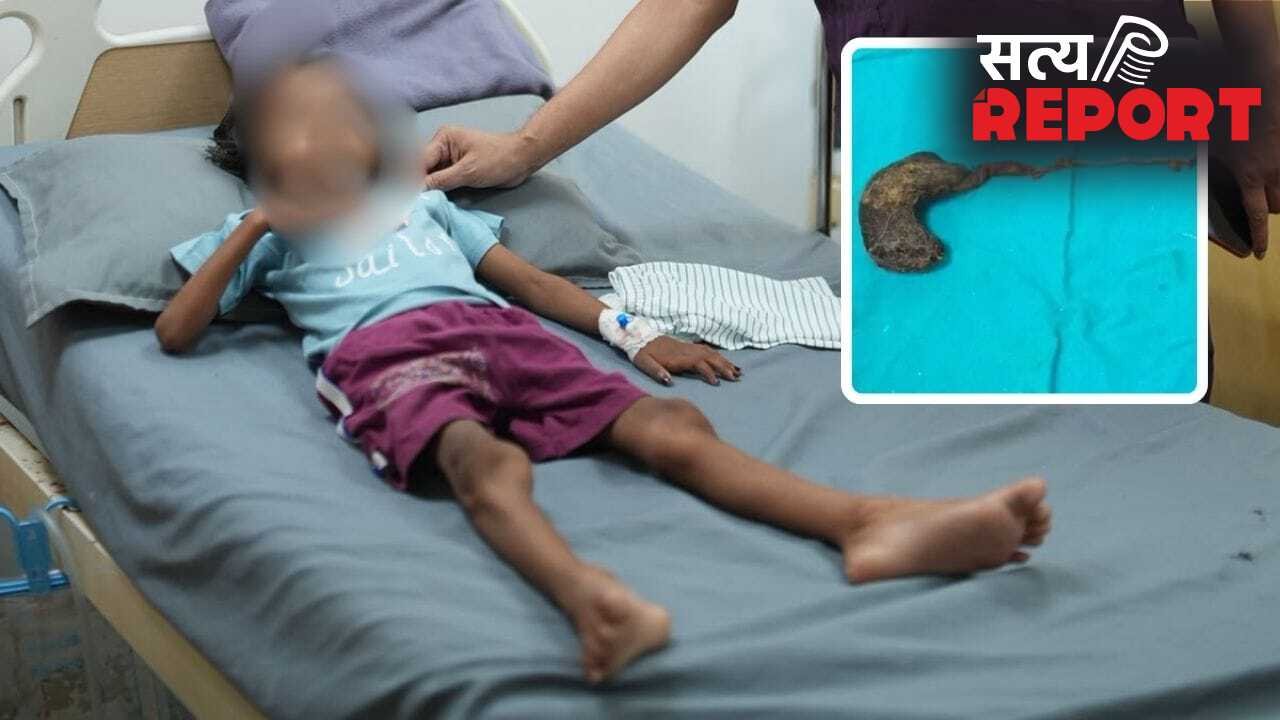 गोरखपुर में 7 साल की बच्ची के पेट से निकला बालों का गुच्छा, डॉक्टर भी रह गए हैरान; बाल खाने की आदत थी