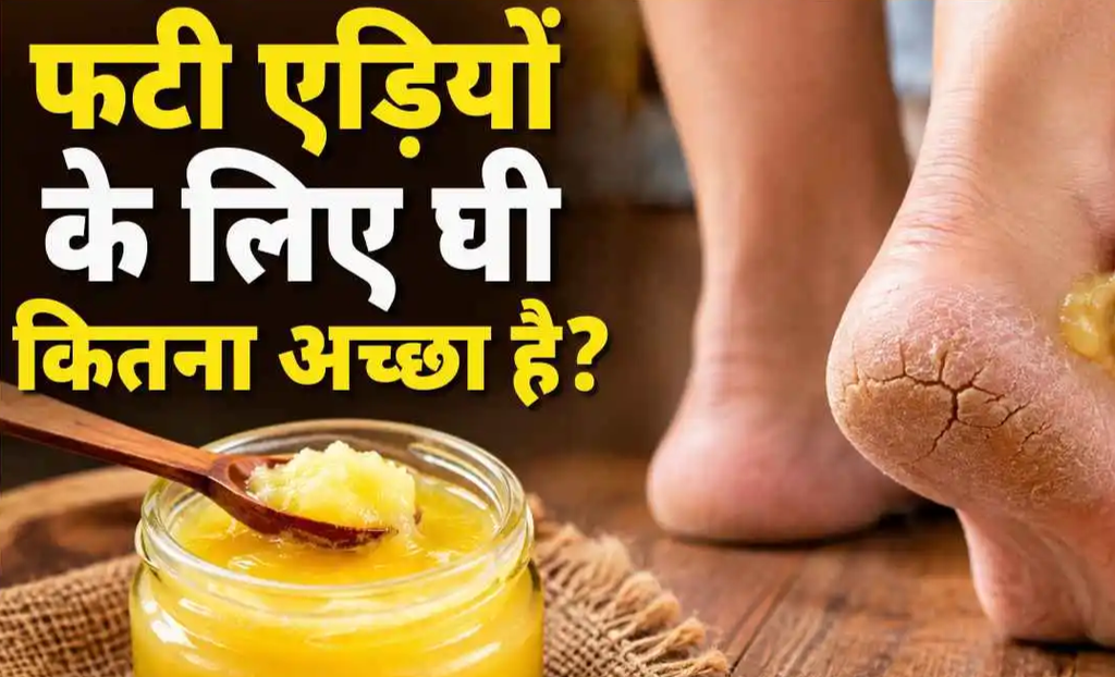 फटी एड़ियों से हैं परेशान? रात में ऐसे लगाएं देसी घी, त्वचा की ड्राईनेस से मिल सकती है राहत. फटी एड़ियों से हैं परेशान? रात में ऐसे लगाएं देसी घी, त्वचा की ड्राईनेस से मिल सकती है राहत.